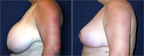 Ohio breast reduction patient pictures